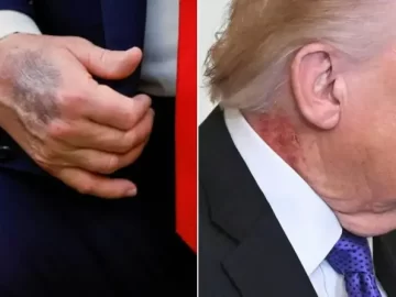 Trump neck redness explained as doctor issues official statement