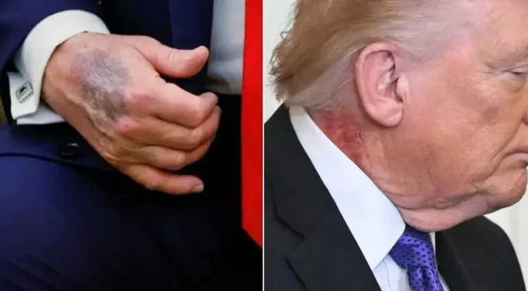 Trump neck redness explained as doctor issues official statement