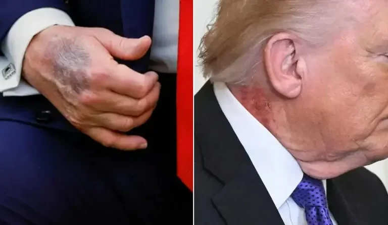 Trump neck redness explained as doctor issues official statement